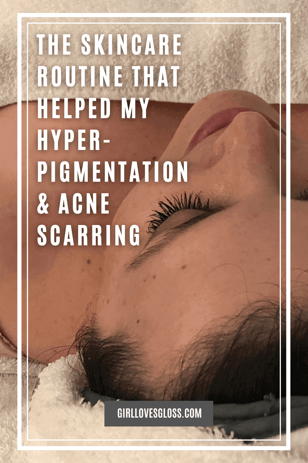 Vivier Skin Review How I Beat Hyperpigmentation and Acne Scarring